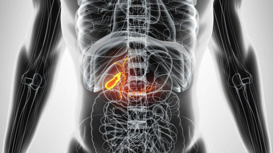 E se eu tenho cálculos na vesícula e não  operar? 